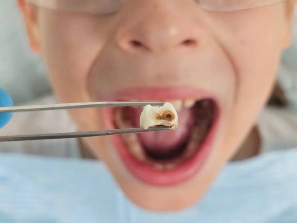 Best Emergency Root Canal Therapy in Barker Heights, NC