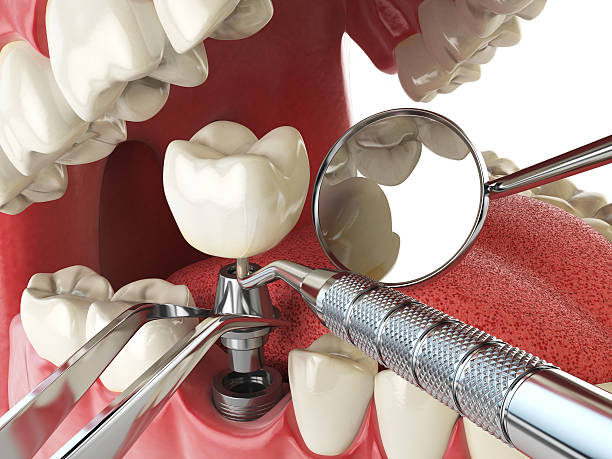 Best Emergency Cosmetic Dentistry (e.g., broken veneers) in Barker Heights, NC